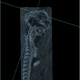 Detailed micro-CT scan of the stillborn baby, showing the malformed skull.